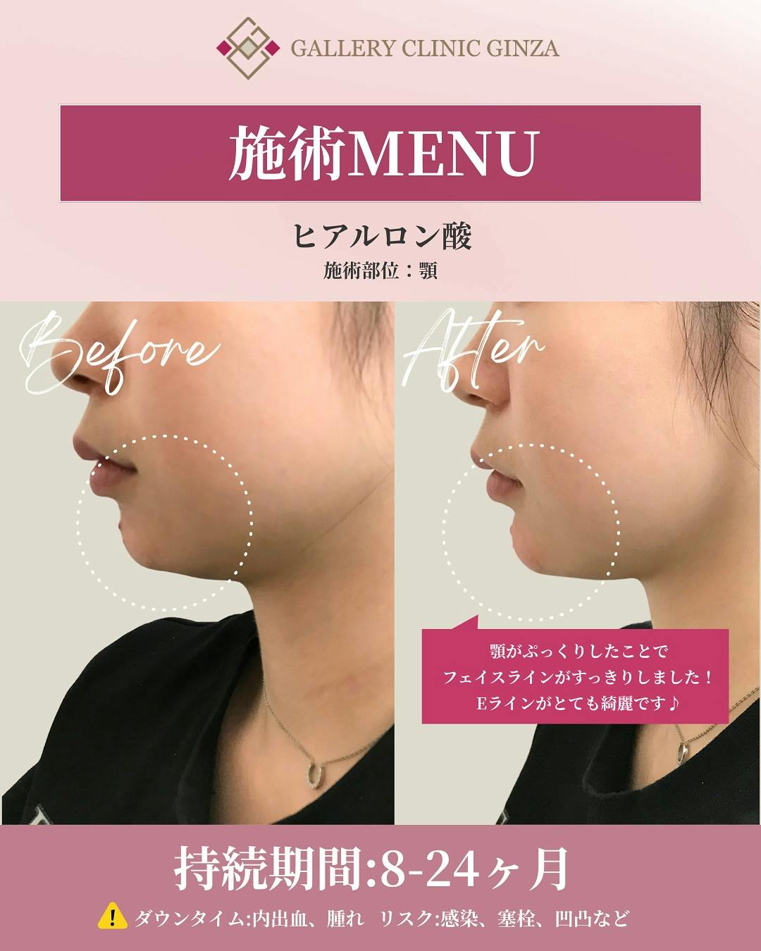 【女性・顎】ヒアルロン酸(あご)_before_aftar