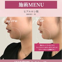 【女性・顎】ヒアルロン酸(あご)_before_aftar