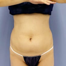 【女性・腹部】Aquicell(アキーセル)脂肪吸引、根こそぎVASER脂肪吸引_before