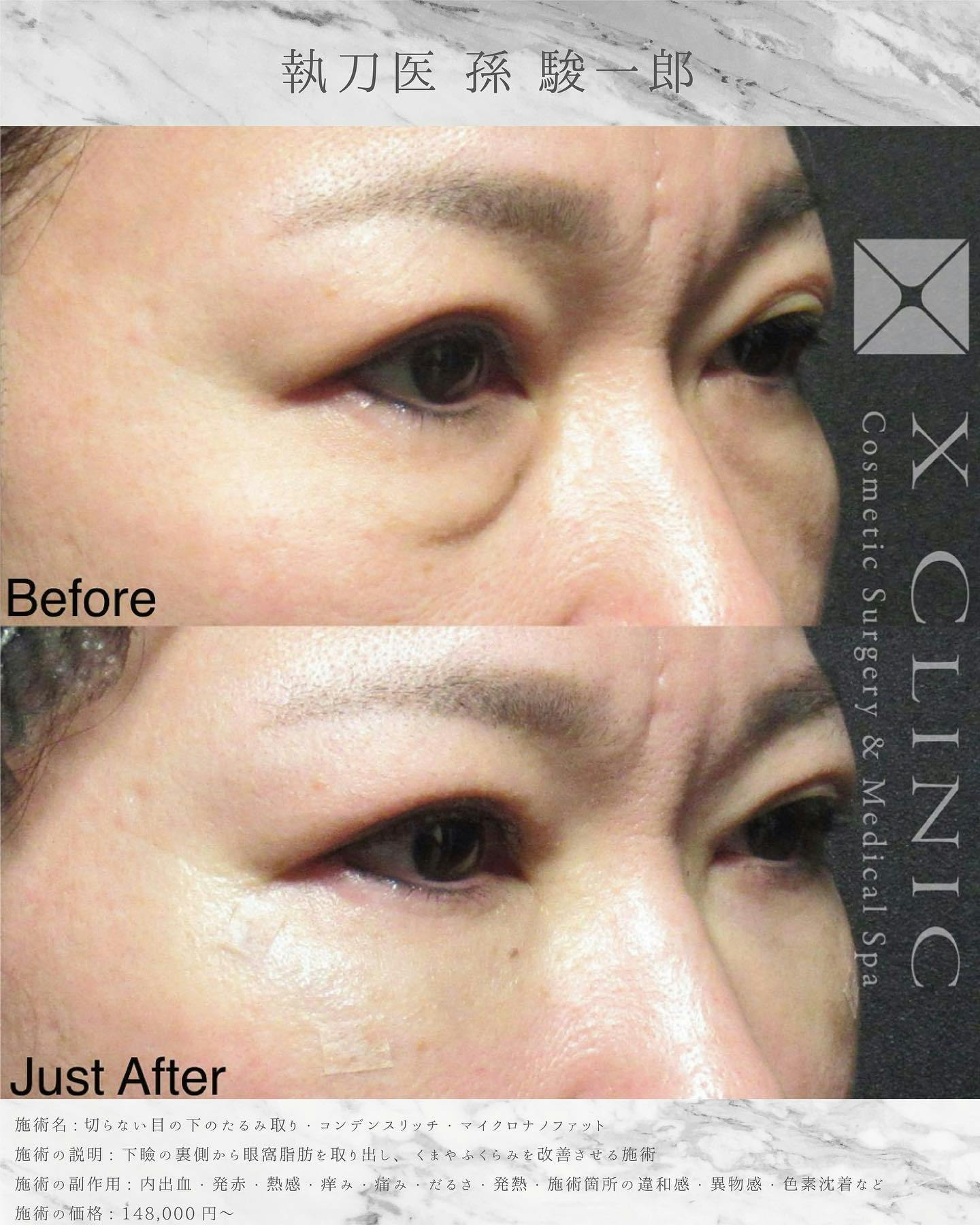 【女性・目元】クマ取りフルコース_before_aftar