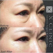 【女性・目元】クマ取りフルコース_before_aftar