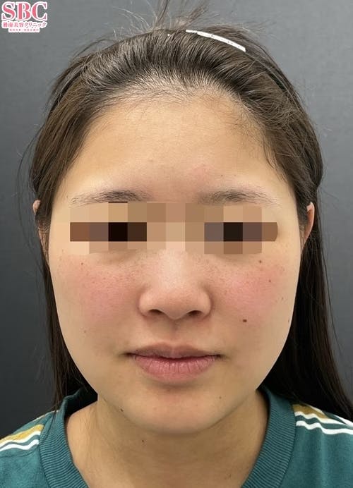 【女性・顔】美ボディ脂肪吸引、メーラーファット除去術、ボトックス_before