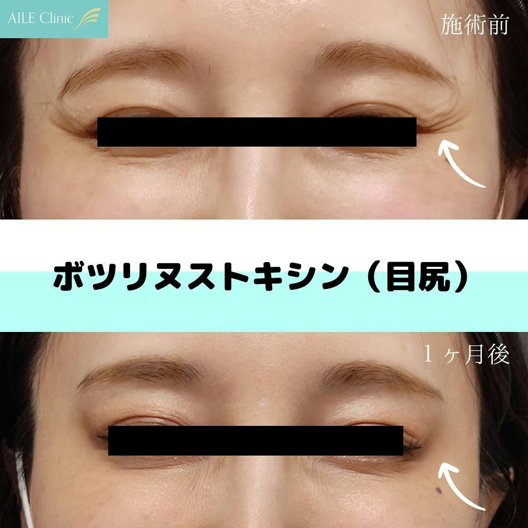 ボトックス注射ができる美容クリニックの症例写真・ビフォーアフター・経過写真一覧, image size:1080x1080