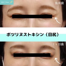 【女性・シワ】ボツリヌストキシン注入_before_aftar