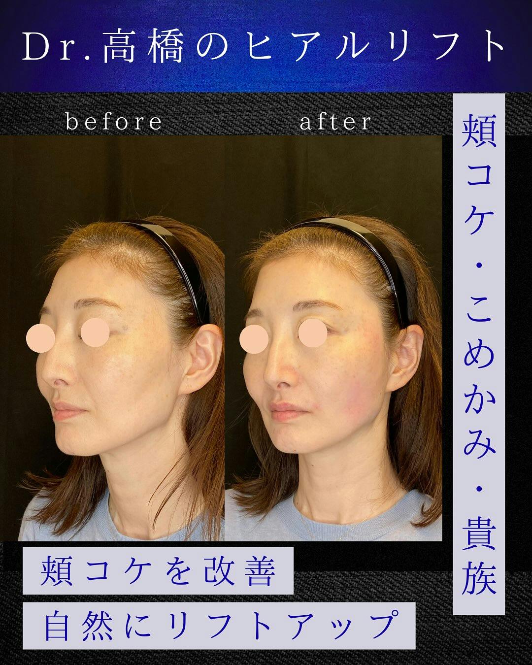 【女性・顔】ヒアルロン酸注入_before_aftar