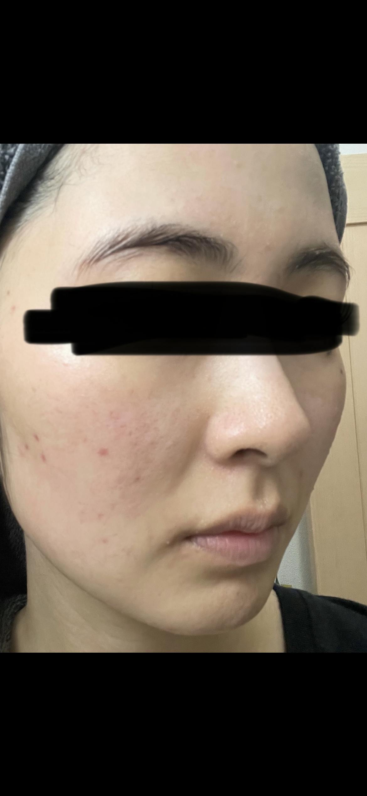 渋谷美容外科クリニック 横浜院でケミカルピーリングを受けたははるさんの写真