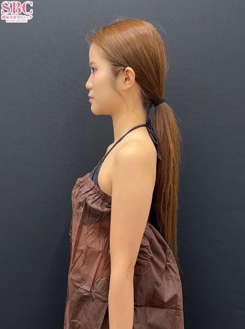 【女性・二の腕】Aquicell（アキーセル）脂肪吸引_before