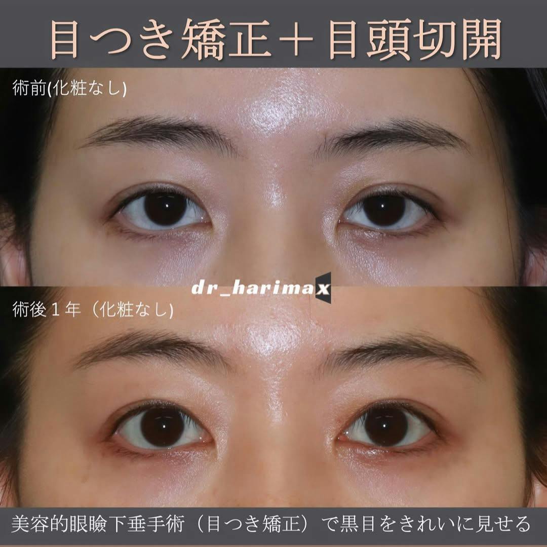 【女性・目】美容的眼瞼下垂手術・眉下切開_before_aftar