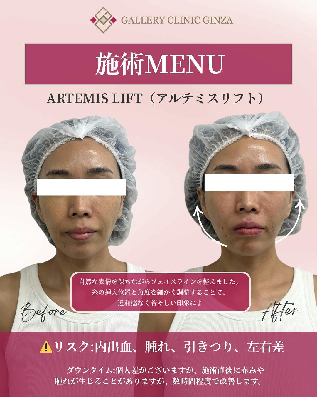 【女性・たるみ】アルテミスリフト_before_aftar