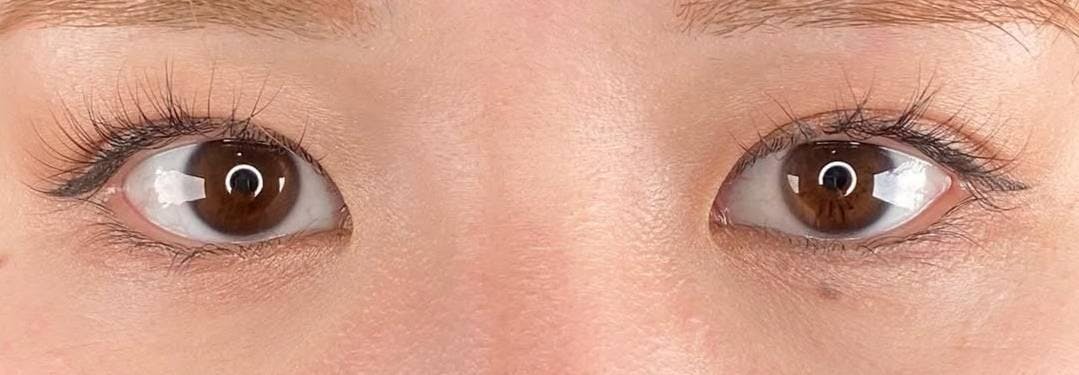 横浜TAクリニックで二重整形・目元：二重切開（全切開法）を受けたばにーさんの写真