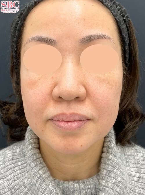 【女性・輪郭】Aquicell（アキーセル）脂肪吸引 ジョールファット除去術 メーラーファット除去術_before