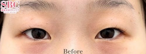 【10代女性・目元】目頭切開プレミアム・線留めクロス二重術_before