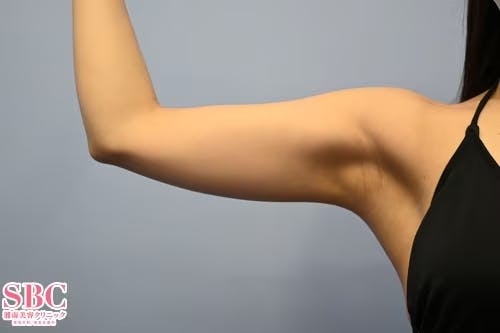 【女性・二の腕】根こそぎVASER脂肪吸引、ライポマティック脂肪吸引、Aquicell（アキーセル）脂肪吸引_before