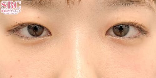 【女性・目元】目の下の切らないクマ・たるみ（ふくらみ）取り、ナチュラル脂肪注射ナノリッチ、ナチュラル脂肪注射コンデンスリッチ_after