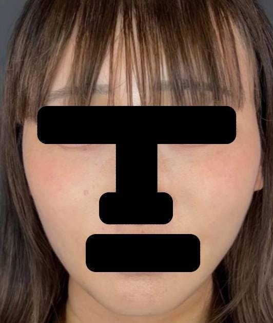 みずほクリニックで顎下の脂肪吸引（首回りの脂肪吸引）：べイザー脂肪吸引を受けた乾杯さんの写真