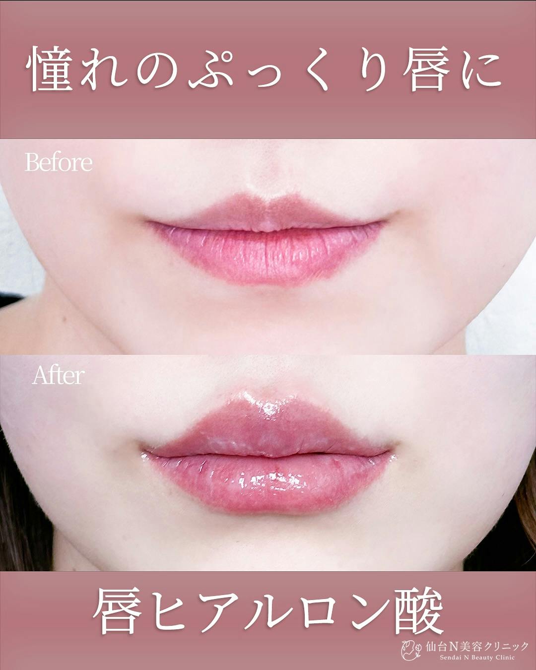 【女性・唇】ヒアルロン酸 ボルベラ_before_aftar
