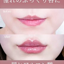 【女性・唇】ヒアルロン酸 ボルベラ_before_aftar