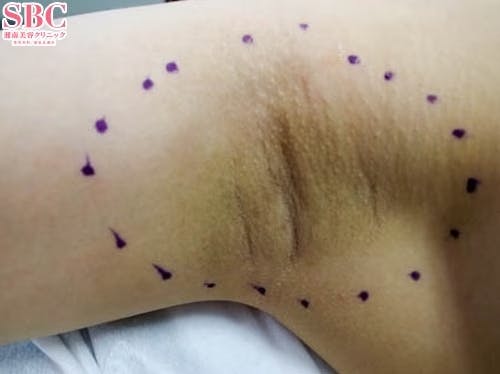 【女性・ワキ】ベイザーシェービング法、シェービング法、完全摘出法_before