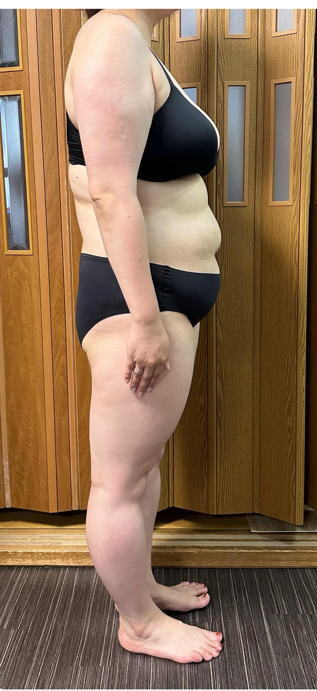 湘南美容クリニック 大阪梅田本院で医療痩身・ダイエット・ダイエットピル(痩身内服薬)を受けたnaagiiさんの写真