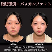 【20代女性・顔】脂肪吸引プレミアム(頬+顎下)+ バッカルファット除去_before_aftar