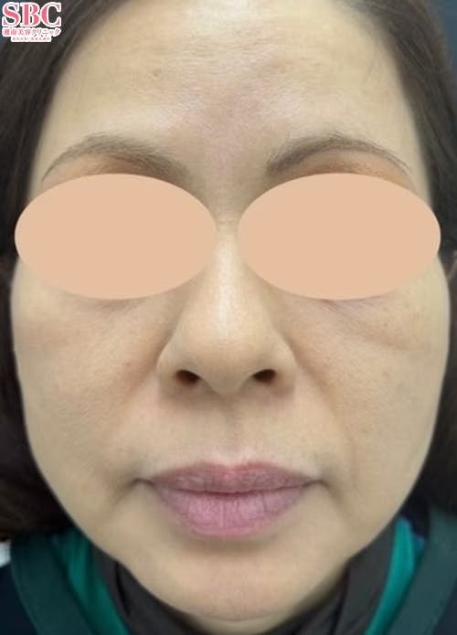 【50代女性・輪郭】VOV（ボブ）リフト・プリマリフト・ヒアルロン酸ジュビダームビスタ バイクロスシリーズ_after