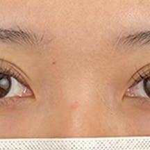 【20代女性・目元】線留めクロス二重術_1week