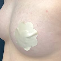 【女性・胸】コンデンスリッチ(脂肪注入豊胸)_aftar