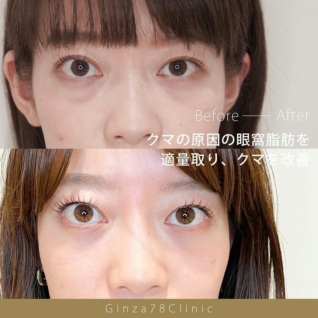 【女性・目元】目の下のクマ取り_before_aftar