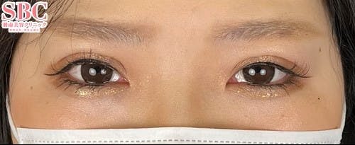 【女性・目元】線留めクロス二重術_after