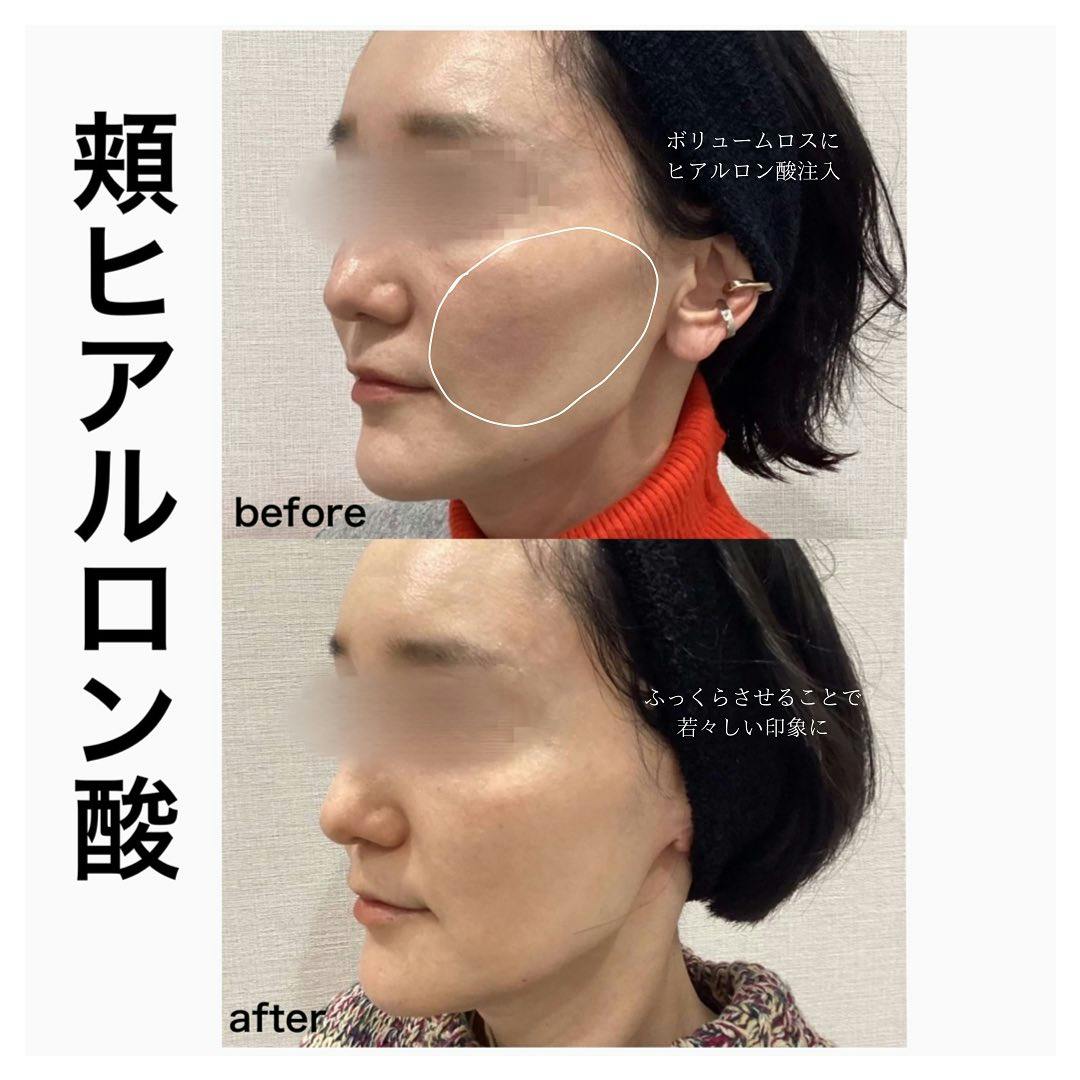 【女性・頬】ヒアルロン酸_before_aftar