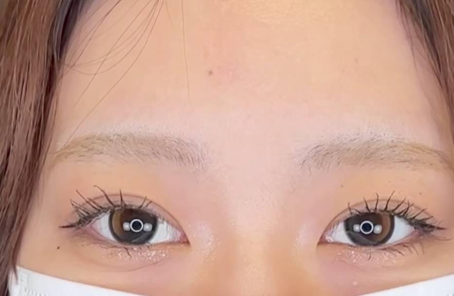 湘南美容クリニック 渋谷院で二重埋没法：Teen二重（両目2点）を受けためいぷるさんの写真