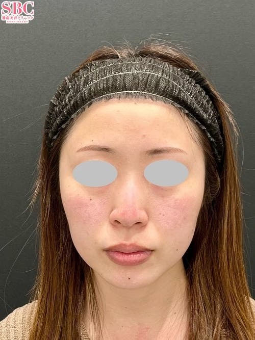 【20代女性・輪郭】プリマリフト_before