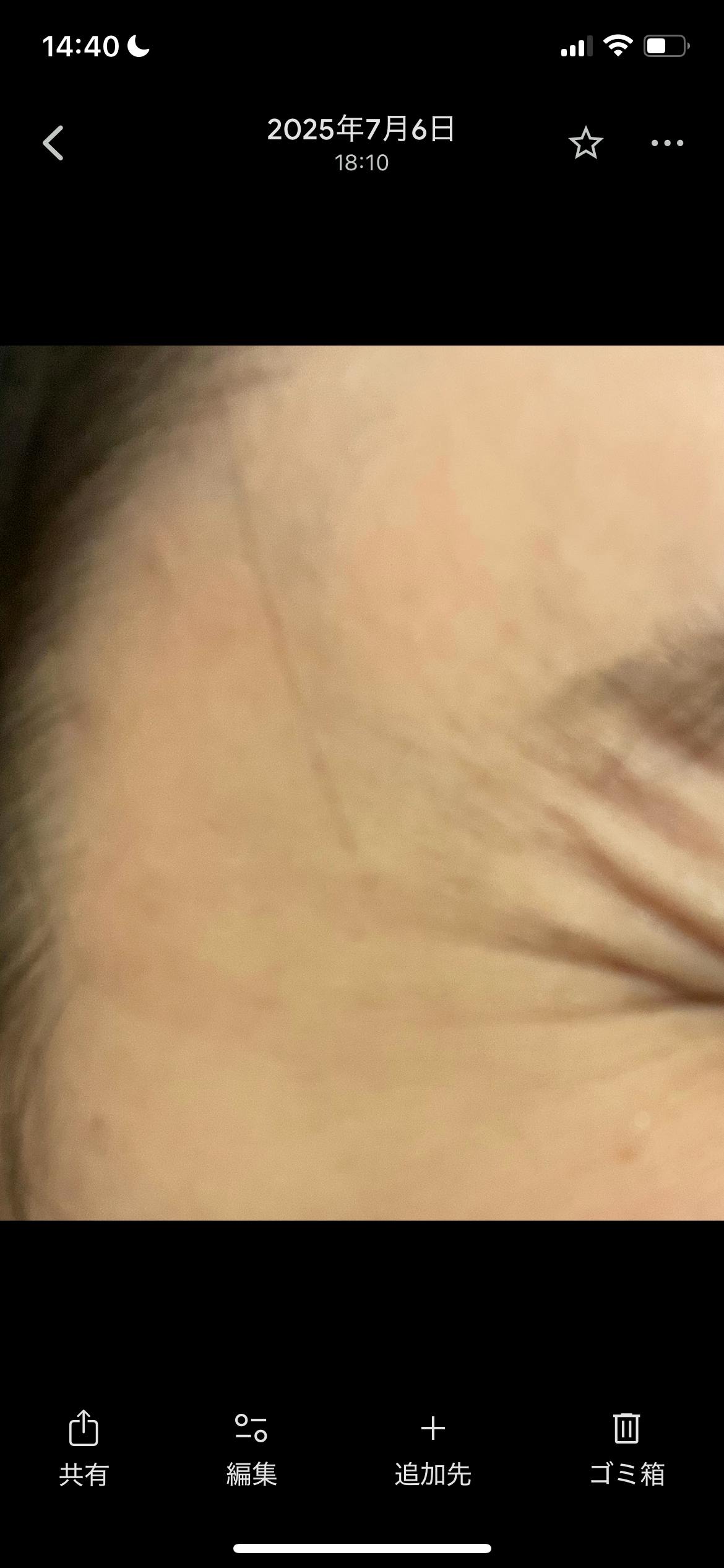 湘南美容クリニック 横浜院で目の下のクマ・たるみ取り・ボトックス注射・ボトックス注射(顎)・目尻ボトックス注射・眉間ボトックス注射・目の下ボトックス注射・おでこ(額)ボトックス注射・バニーライン・鼻根ボトックス注射・韓国製ボトックス・ボツリヌストキシン・クマ取り注射・アラガン製ボトックスを受けたはちわれさんの写真