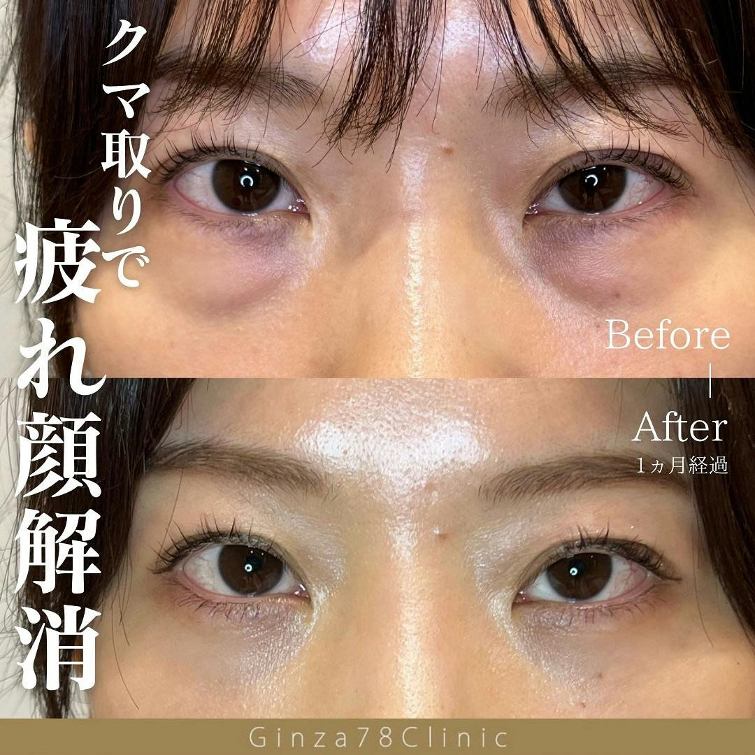 【女性・目元】目の下のクマ取り_before_aftar