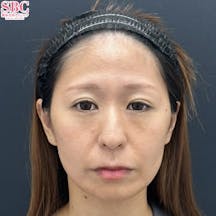 【女性・顔】ヒアルロン酸・女優注射(R)~リジュラン+ボトックス~・うるおいコラーゲンリフト_before