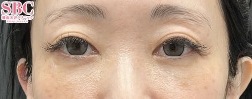 【40代女性・目元】目の下の切らないクマ・たるみ（ふくらみ）取り、ナチュラル脂肪注射コンデンスリッチ、ナチュラル脂肪注射ナノリッチ_after