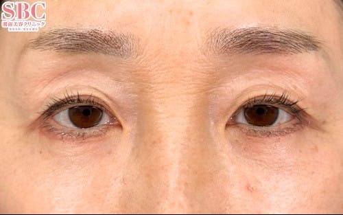 【女性・クマ】アイバックリムーブ法 ナチュラル脂肪注射コンデンスリッチ ナチュラル脂肪注射ナノリッチ_after