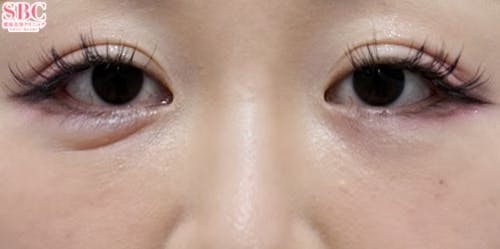 【30代女性・クマ】目の下の切らないクマ・たるみ（ふくらみ）取り、ナチュラル脂肪注射コンデンスリッチ、ナチュラル脂肪注射ナノリッチ_after