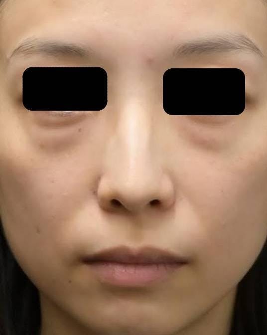 コウベ美容皮膚科 西宮院(KOBE美容皮膚科 西宮院)で目の下の脱脂：目の下の脱脂＋脂肪注入を受けたmaedaさんの写真