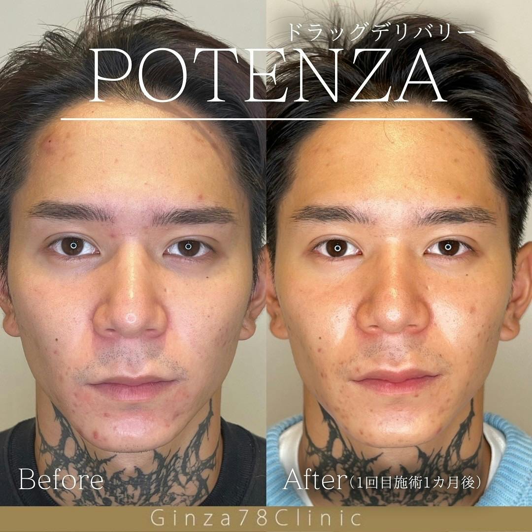【男性・肌質】ポテンツァ ドラッグデリバリー_before_aftar
