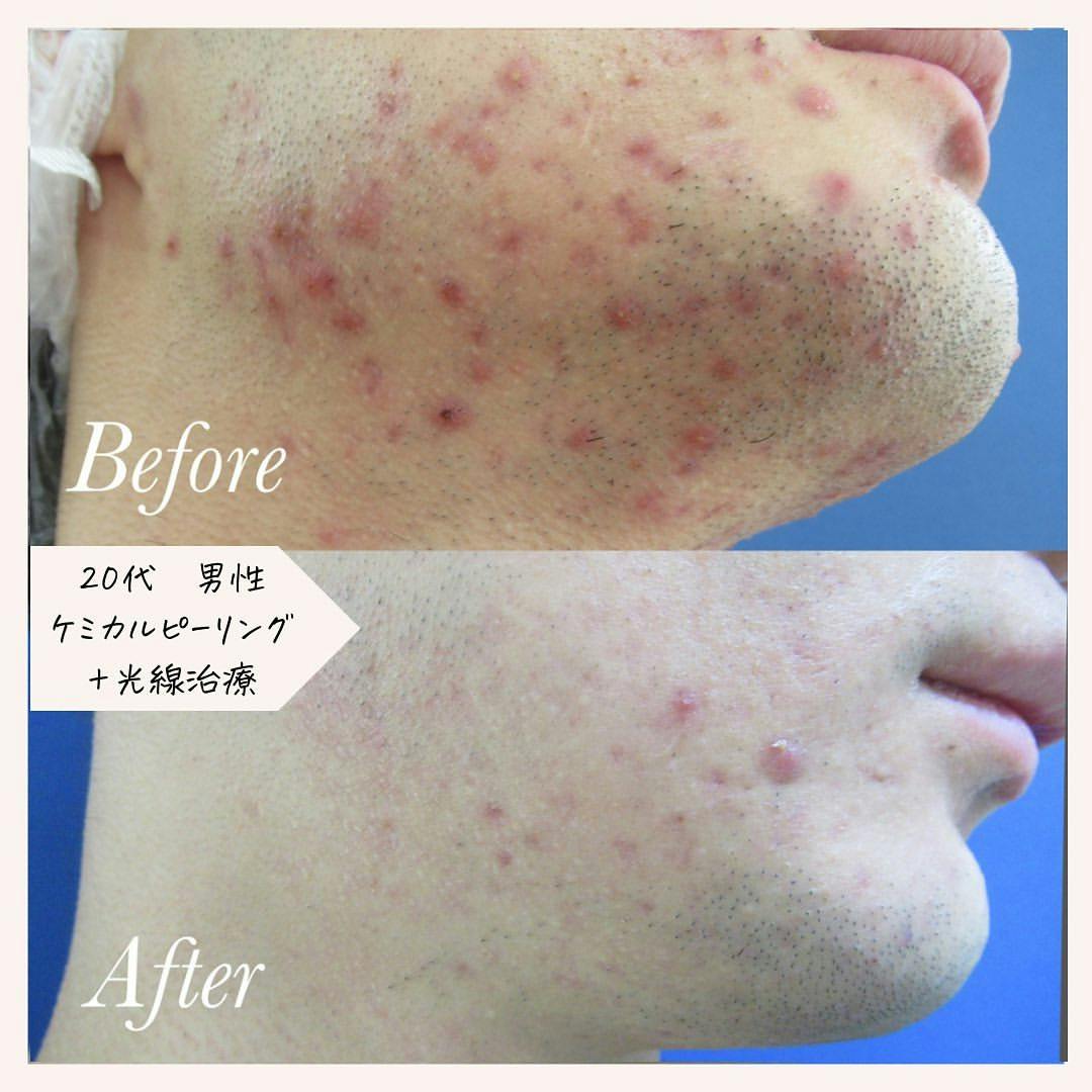 【20代男性・ニキビ】ケミカルピーリング・光線治療_before_aftar
