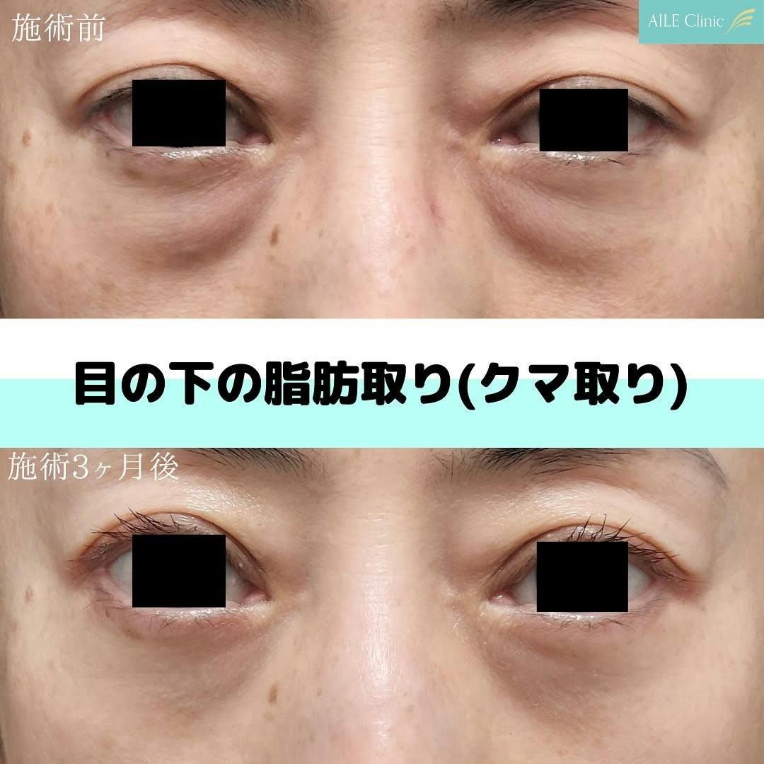 【女性・クマ】目の下の脂肪取り(クマ取り)_before_aftar