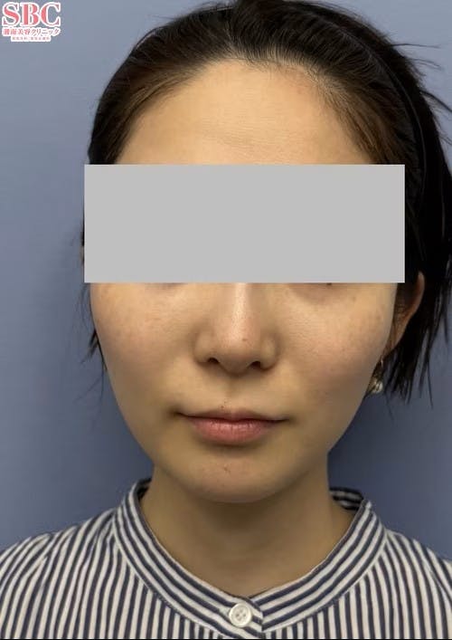 【女性・小顔】ヒアルロン酸ジュビダームビスタ バイクロスシリーズ_before