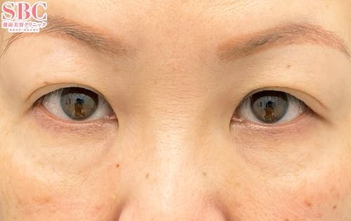 【女性・目元】裏ハムラ法 VOV（ボブ）リフト テスリフト_before