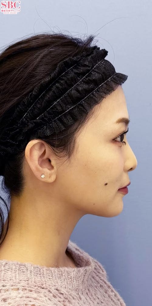 【女性・輪郭】Aquicell（アキーセル）脂肪吸引、根こそぎVASER脂肪吸引_aftar