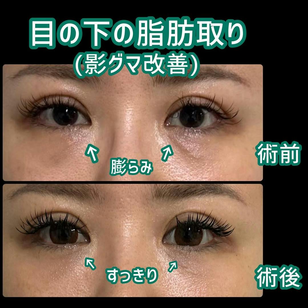 【女性・クマ】目の下の脂肪取り（目のクマ取り）_before_aftar