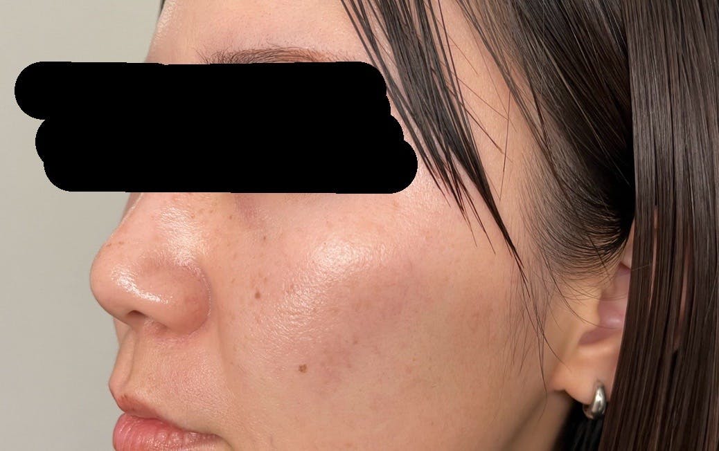 よつば会クリニック 神戸・ハーバーランド院でを受けたまゆさんの写真