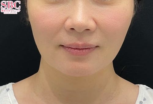 【女性・たるみ】シークレットリフト、プリマリフト、テスリフト_after