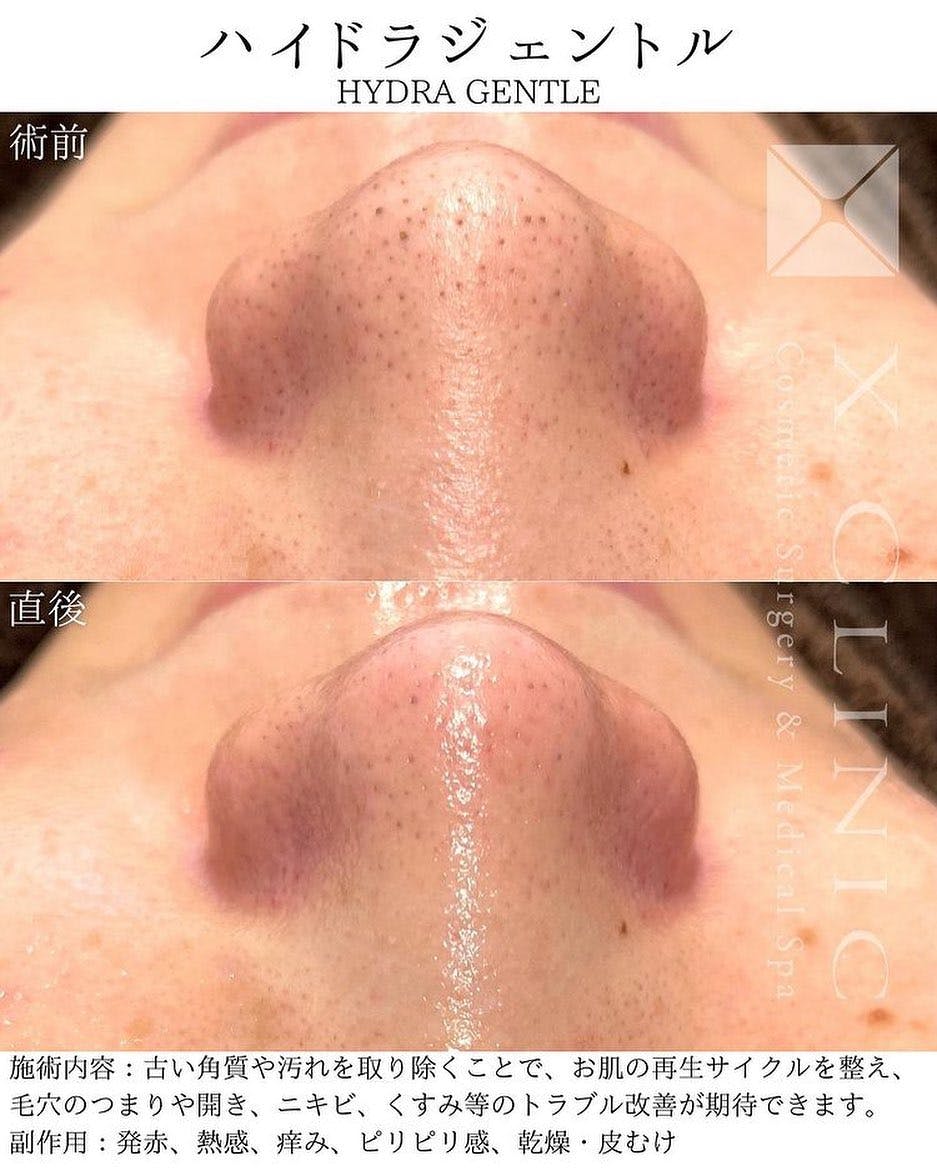 【毛穴】ハイドラジェントル _before_aftar