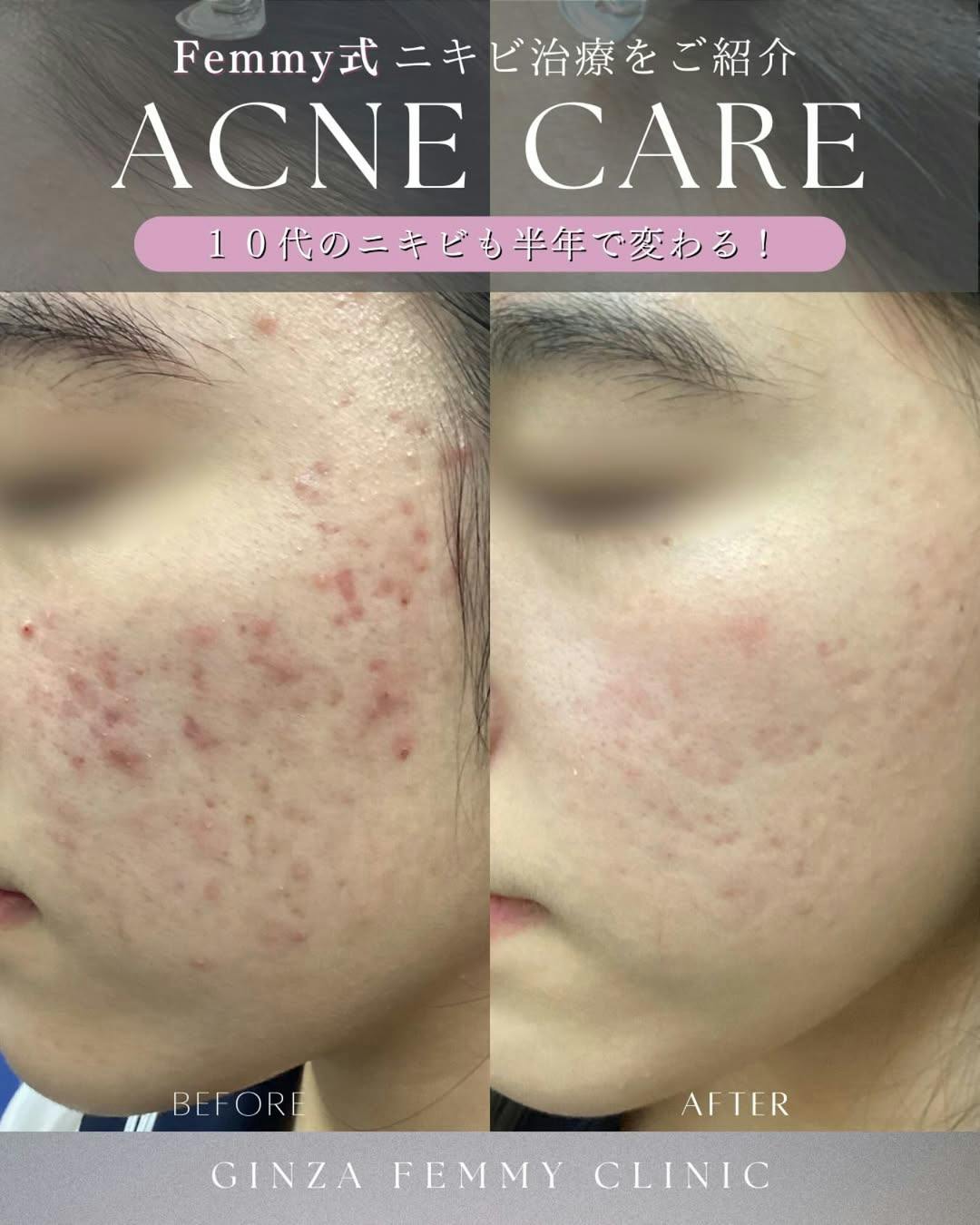 【女性・ニキビ】ケミカルピーリング・クロモライト_before_aftar